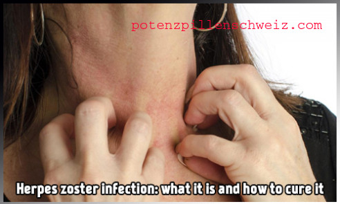 Was ist Herpes Zoster: Wie man erkennt und wie man heilt